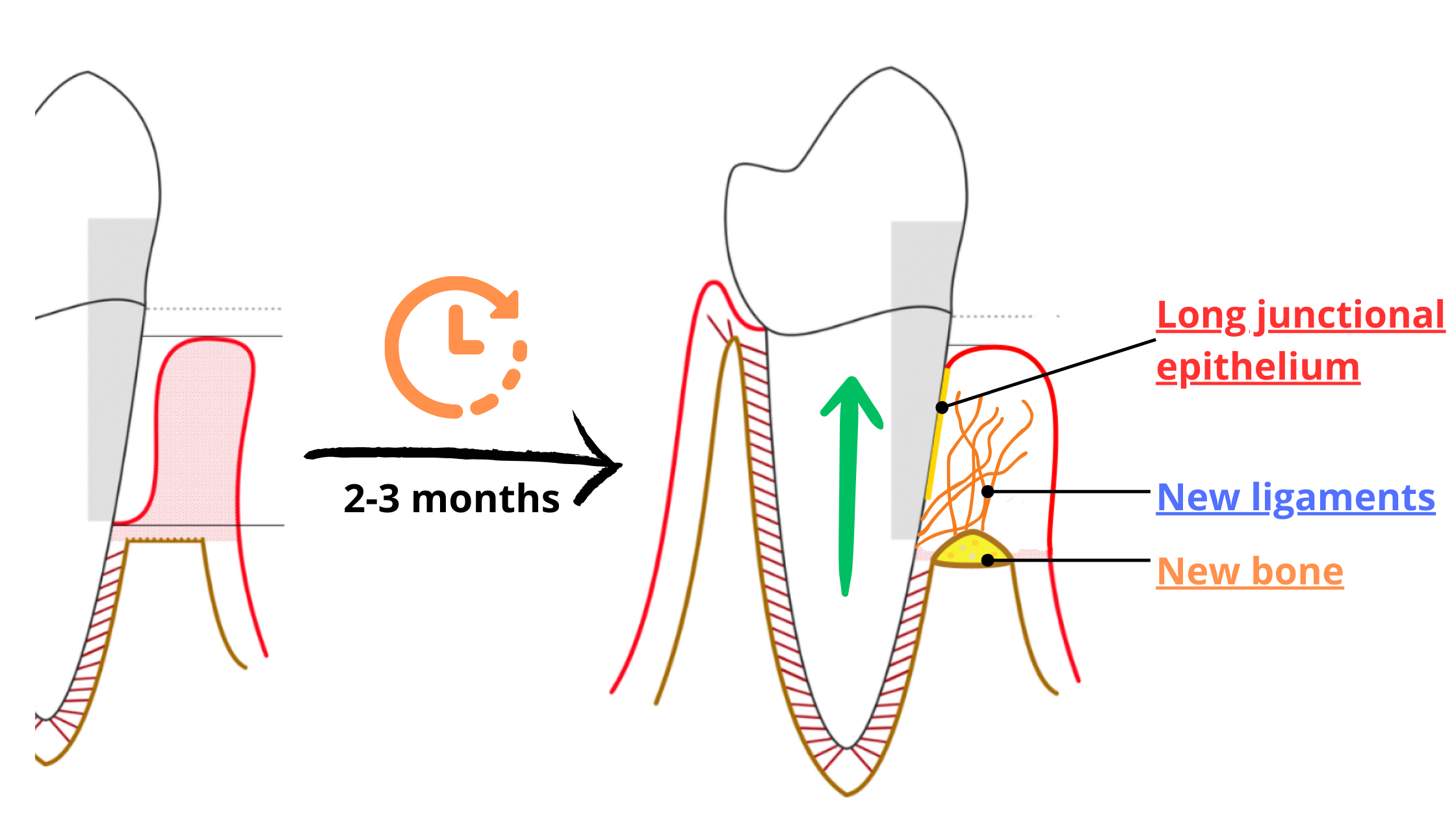 Gum healing and periodontal attachment gain after deep cleaning