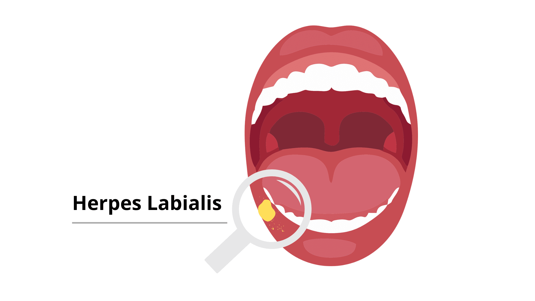 Recurrent herpes infection on the lips (cold sore)