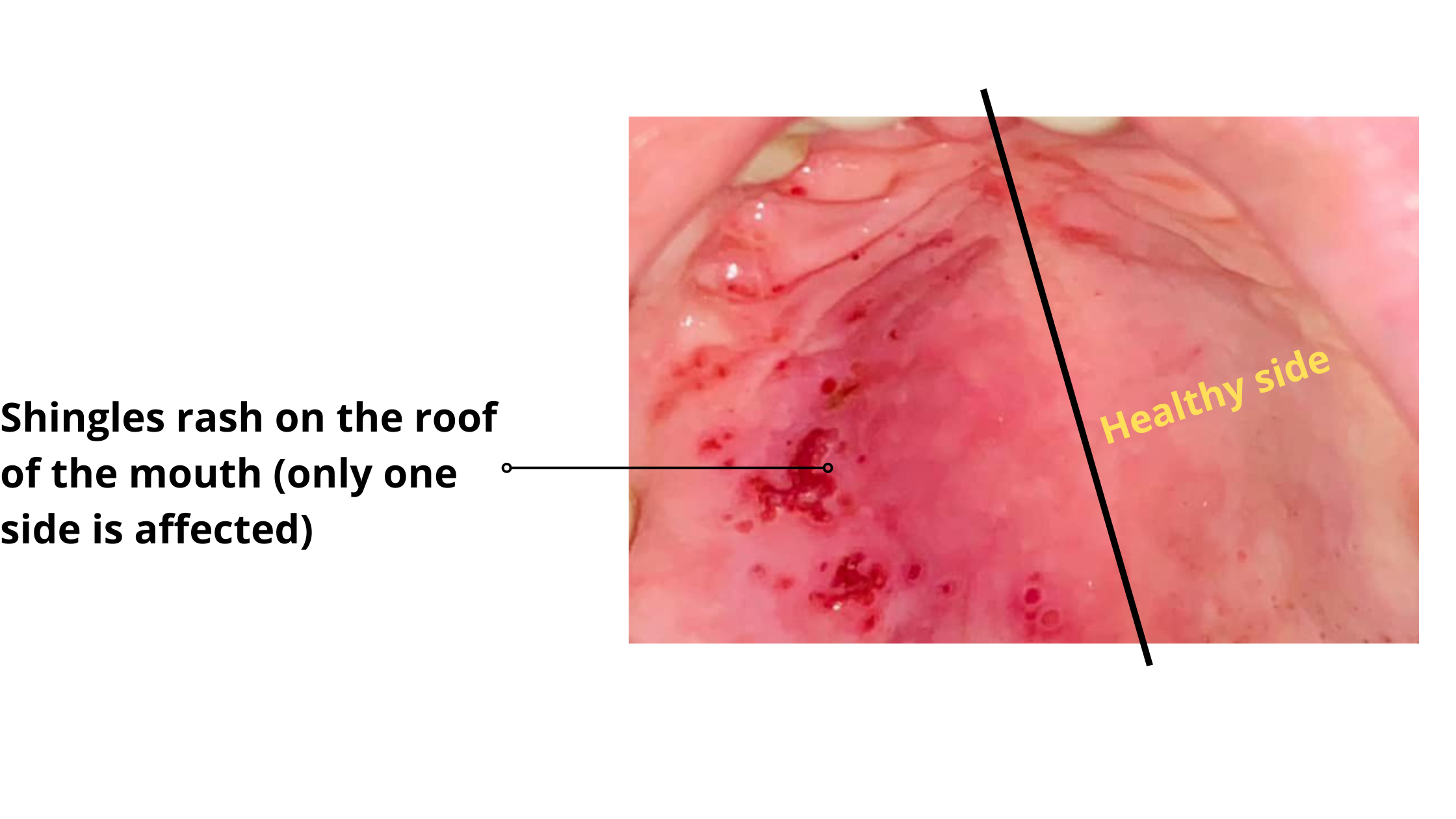 Shingles rash on roof of the mouth (recurrent varicella-zoster virus infection)