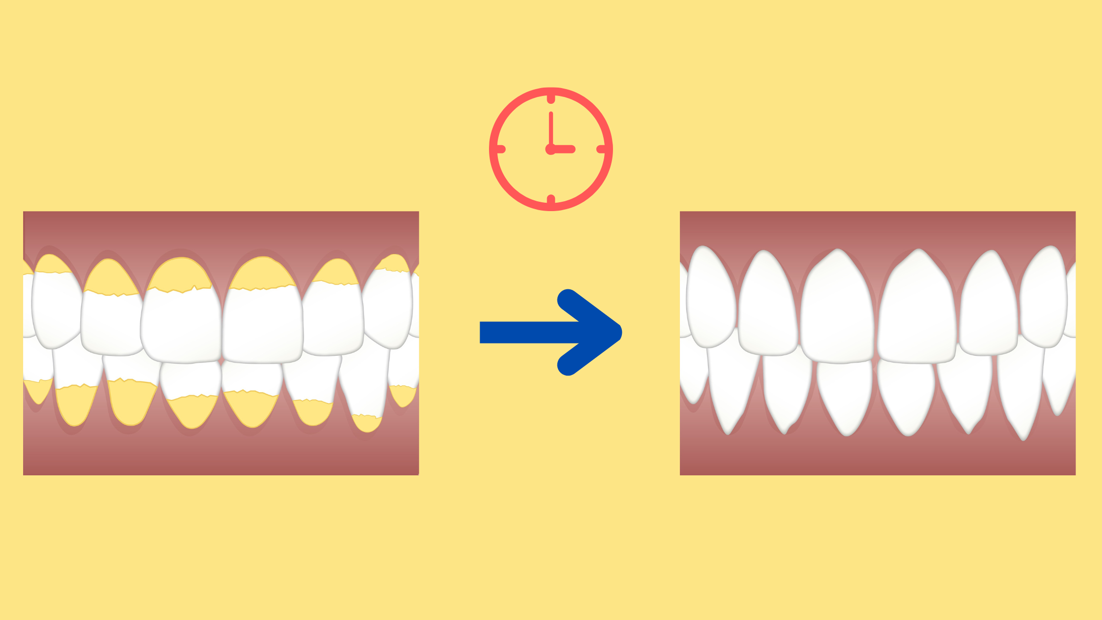 Are Coffee Stains On Teeth Permanent And How To Remove Them For Good