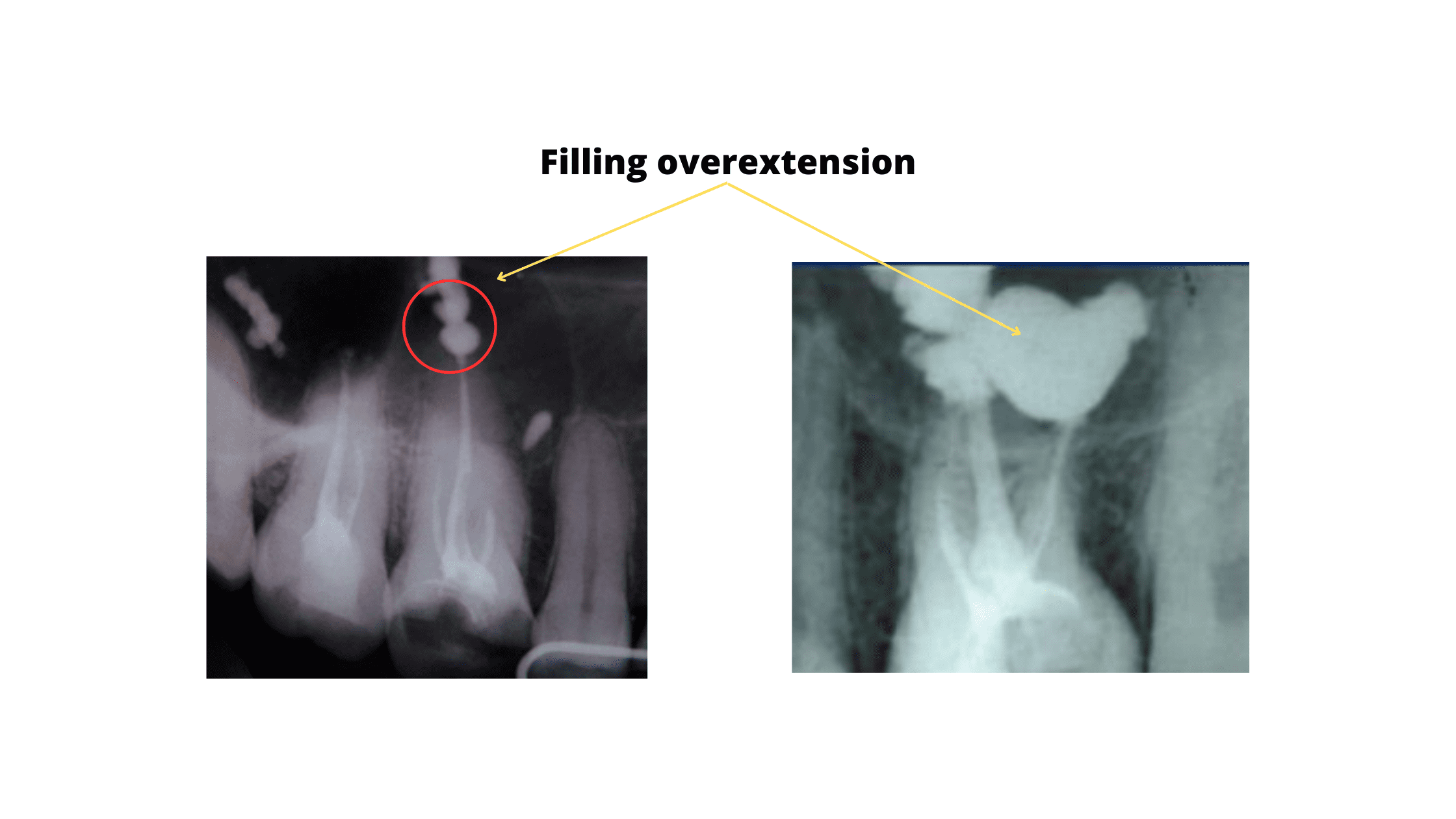 Root canal filling overextending (x-ray image)