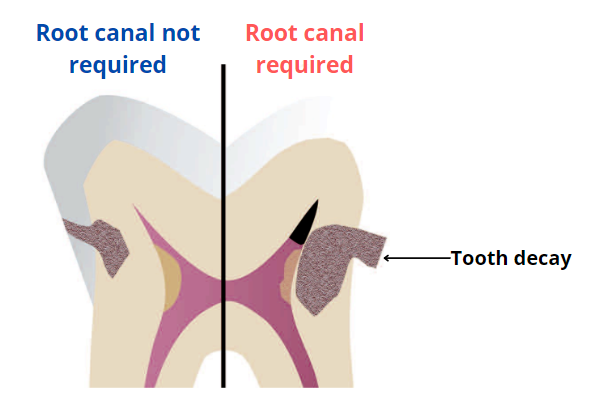 Root canal required vs. Root canal not required