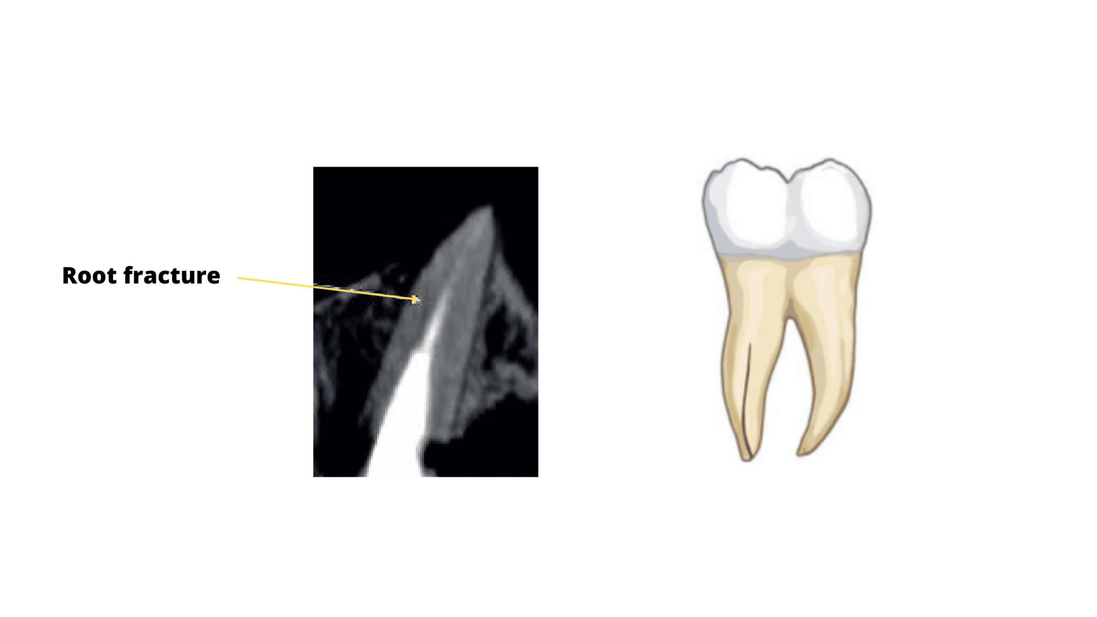 Root fracture after root canal therapy (x-ray image)