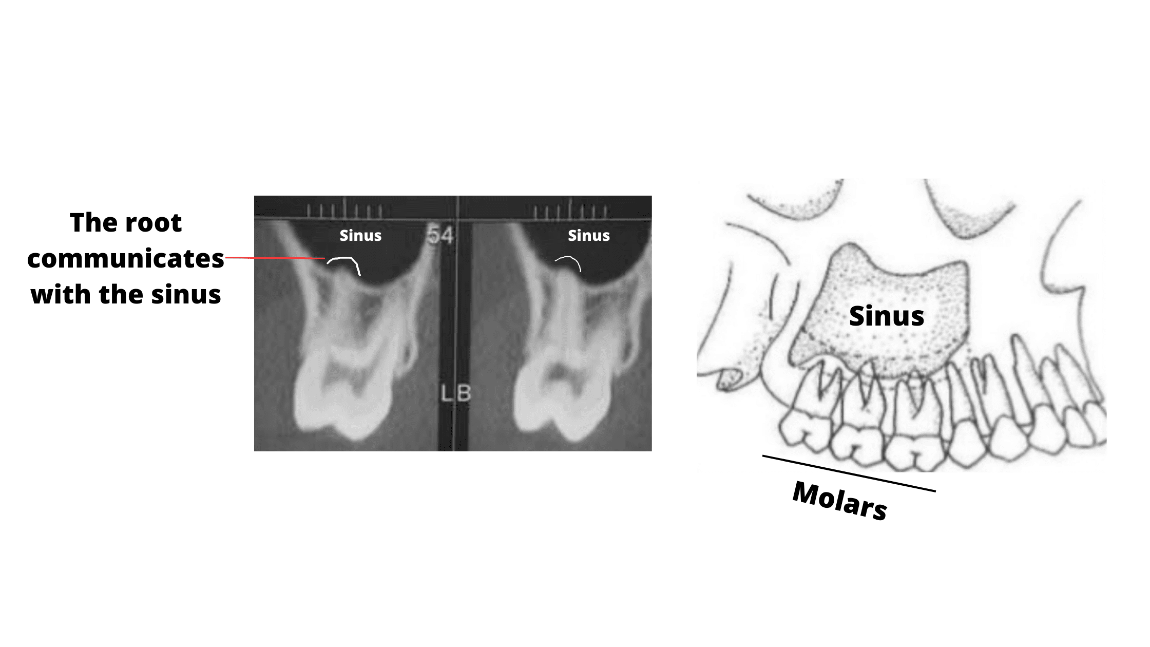 the link between the upper molars and sinuses
