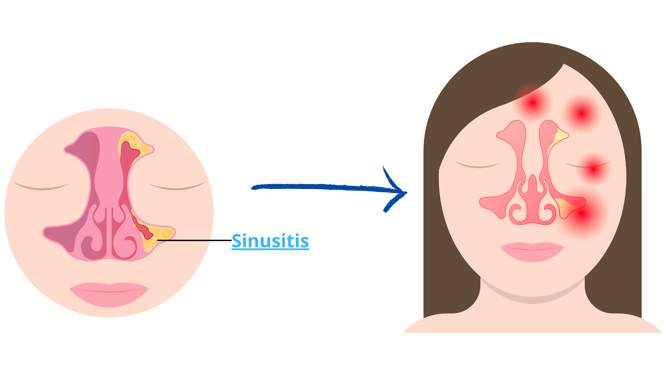 Sinusitis pain can spread to other areas of the face, including the upper jaw, eyes and forehead 