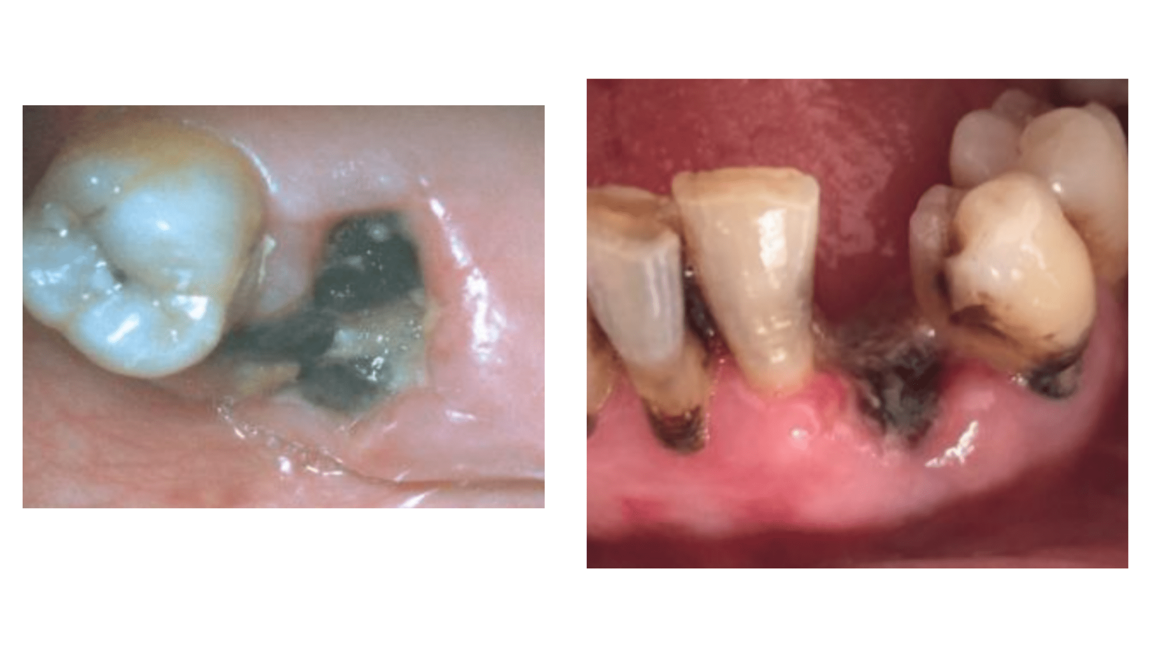 Socket Infection After Tooth Extraction: What You Should Know