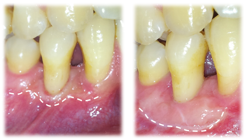 Preventing gum recession from progressing with free gingival graft