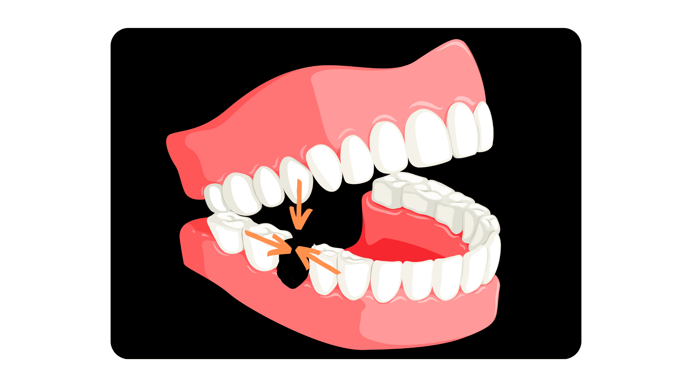 Teeth shifting after tooth extraction
