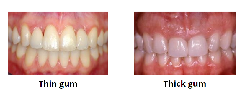 thin gum vs thick gum