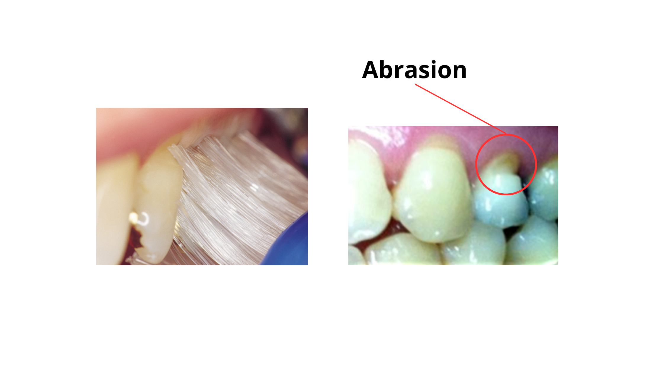 tooth abrasion due to hard toothbrushing
