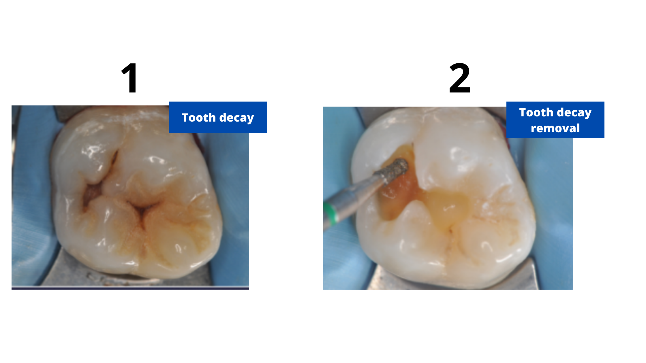 tooth decay removal on a molar tooth