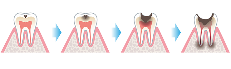 stages of tooth decay