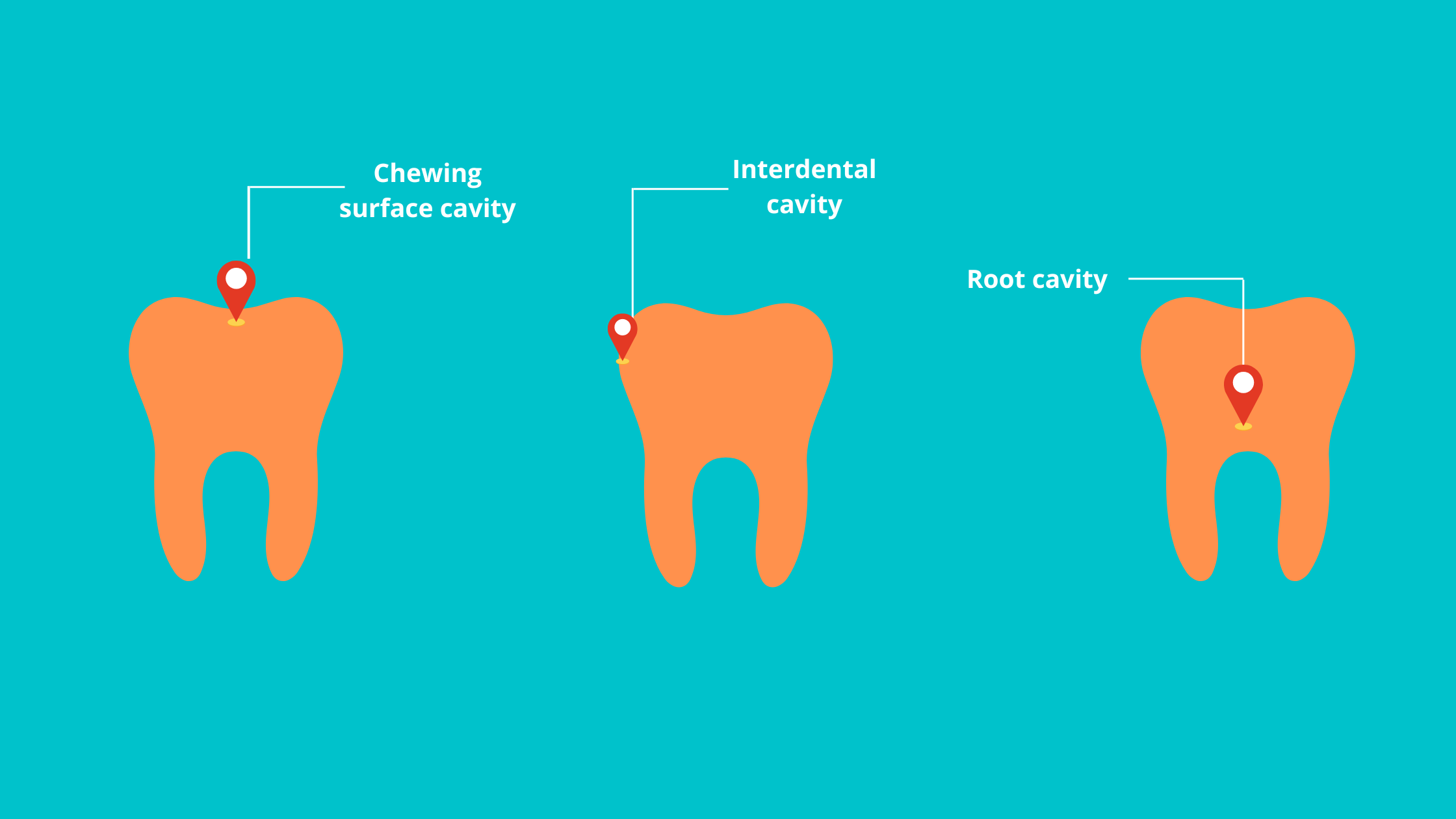 tooth decay types