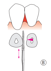 tooth sticks indication