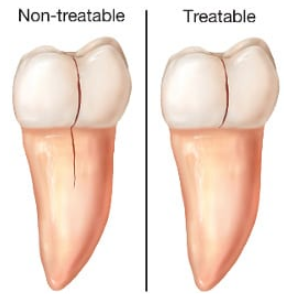 treatable and non-treatable cracked tooth
