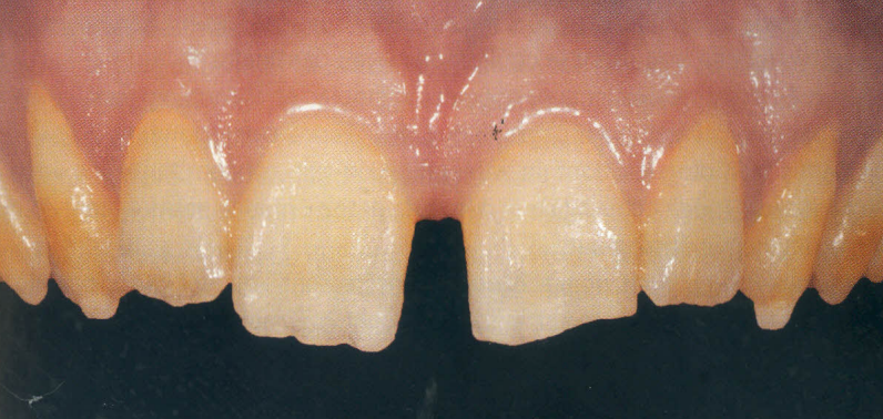 diastema between the two front teeth (incisors)