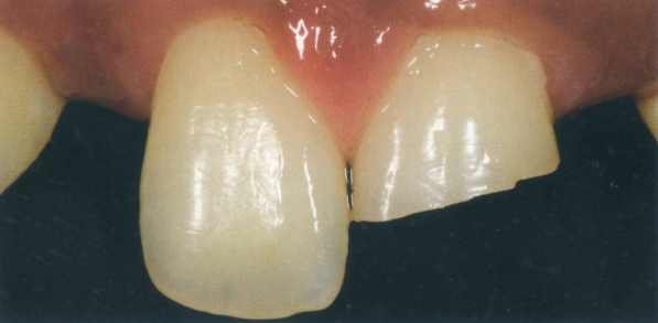 Indication for veneers due to fracture