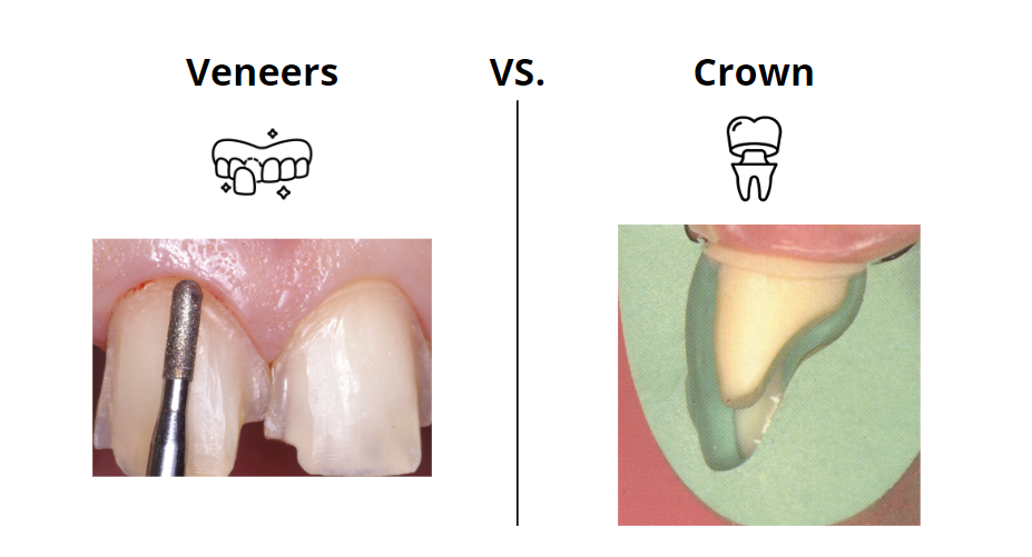 veneers vs crowns